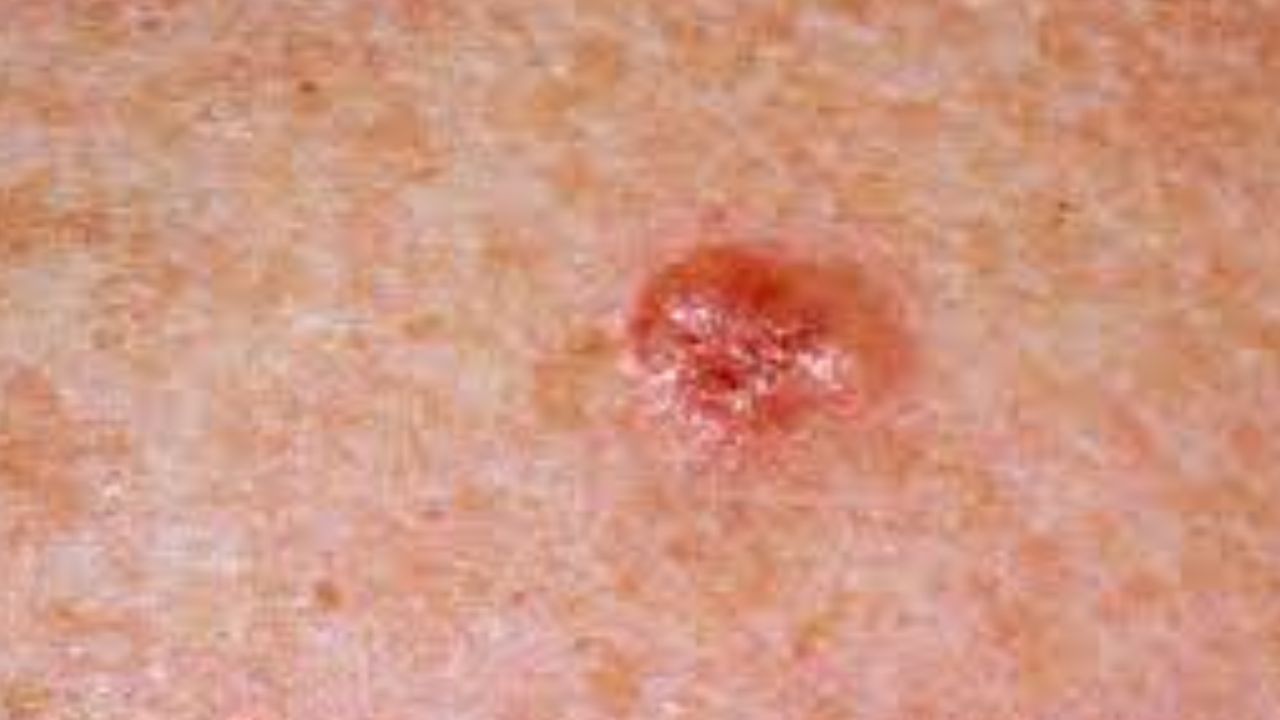 Skin Cancer Study: आखिर क्यों अमीर लोगों में स्किन कैंसर का खतरा होता हैं अधिक, स्टडी में हुआ खुलासा