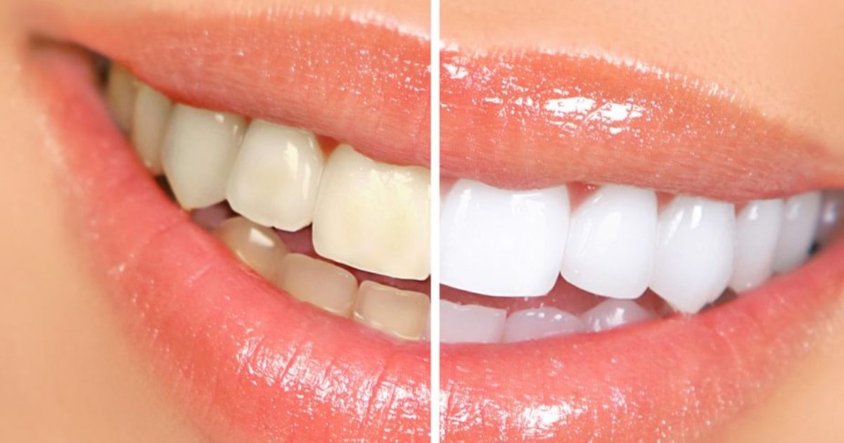 Teeth Whitening tips: दांतों में जमी पीली परत से हैं परेशान, तो इन उपायों को करें फॉलो दूध जैसे चमक जाएंगे दांत