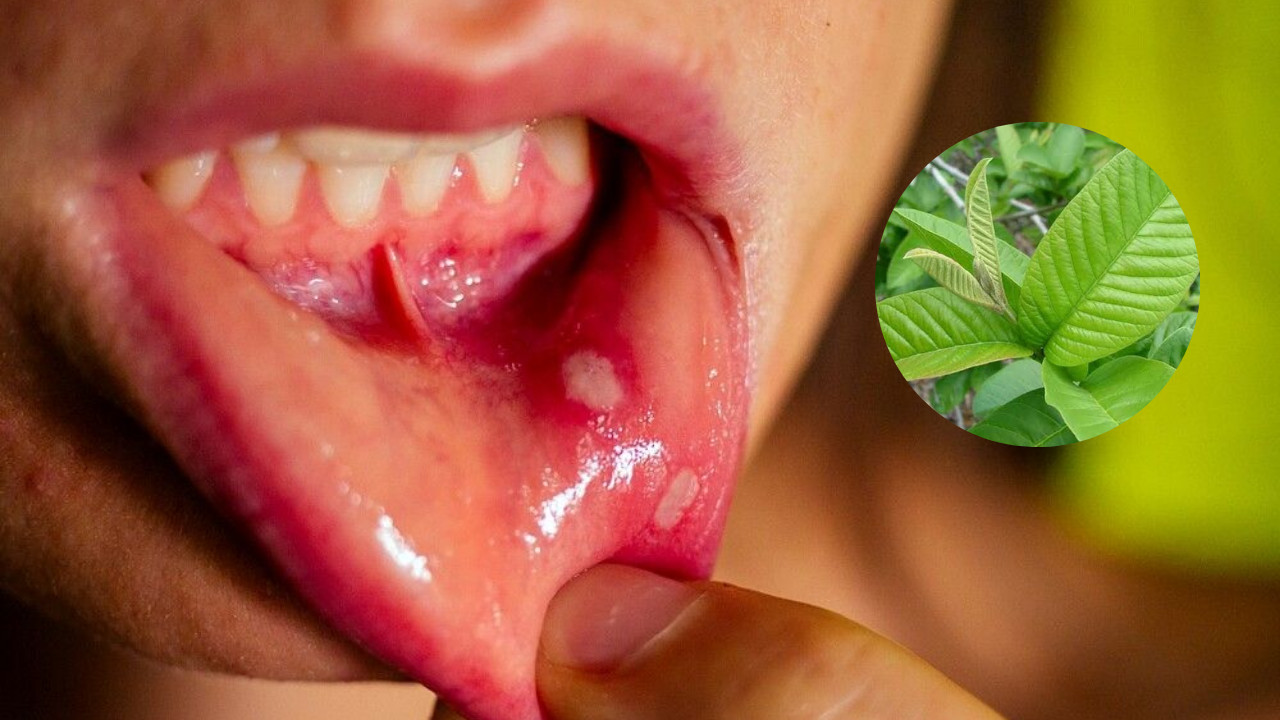 Mouth Ulcer Treatment